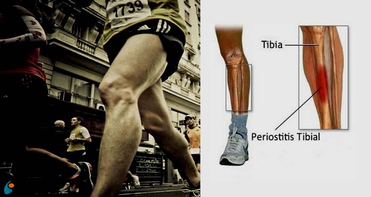 3 TRUCOS PARA RECUPERARTE DE UNA PERIOSTITIS TIBIAL   