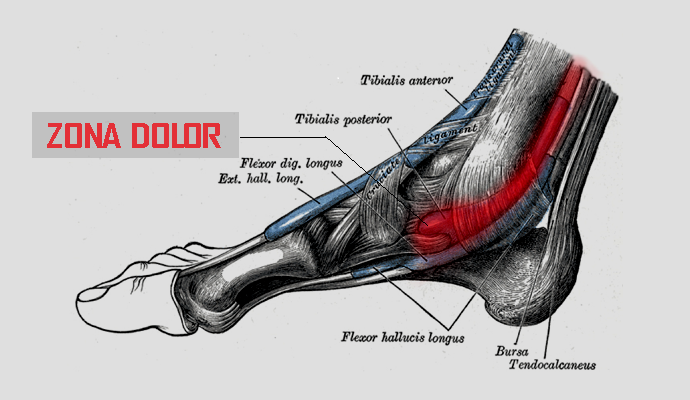 TENDINITIS TIBIAL POSTERIOR