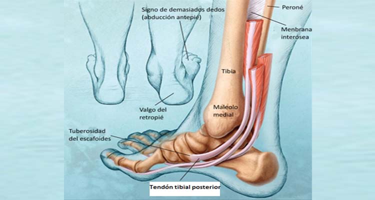 TENDINITIS TIBIAL