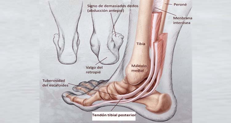 TENDINITIS TIBIAL LESIÓN