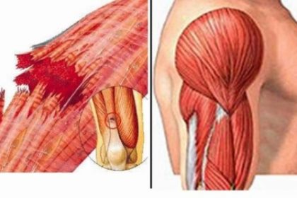 rabdomiolisis