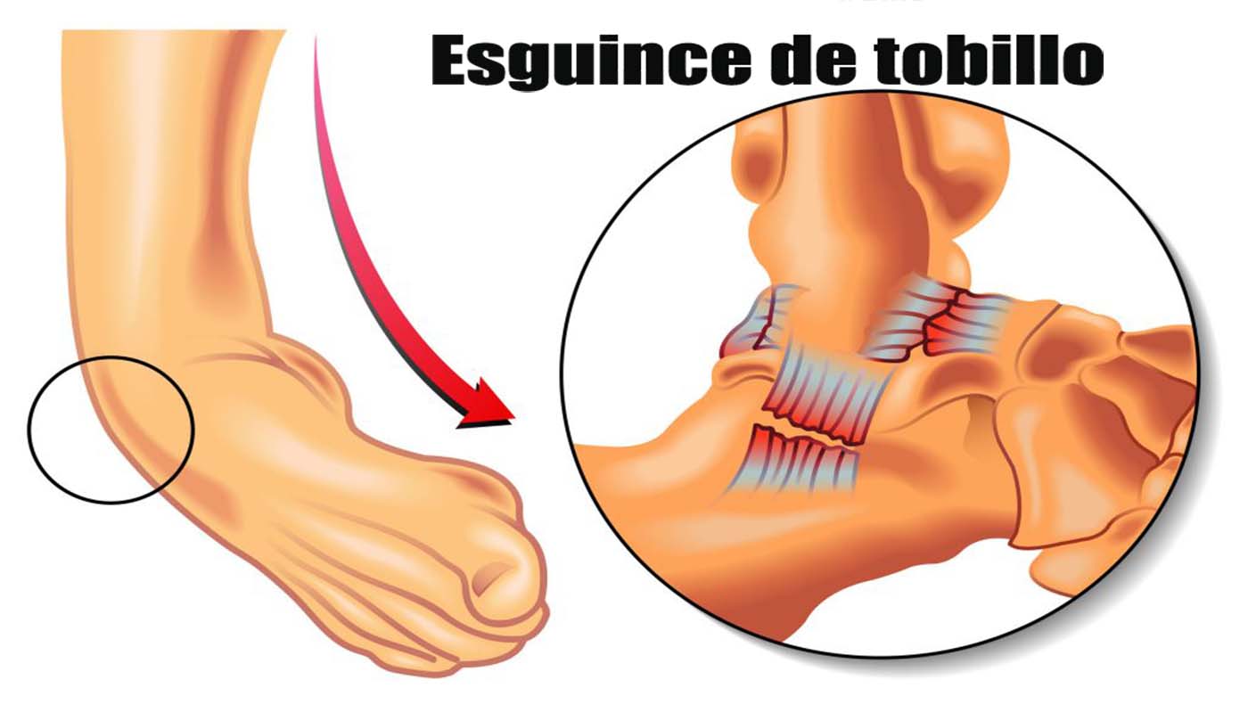 Esguince de tobillo: Síntomas y Tratamientos